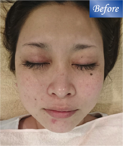 フェイシャルケア before