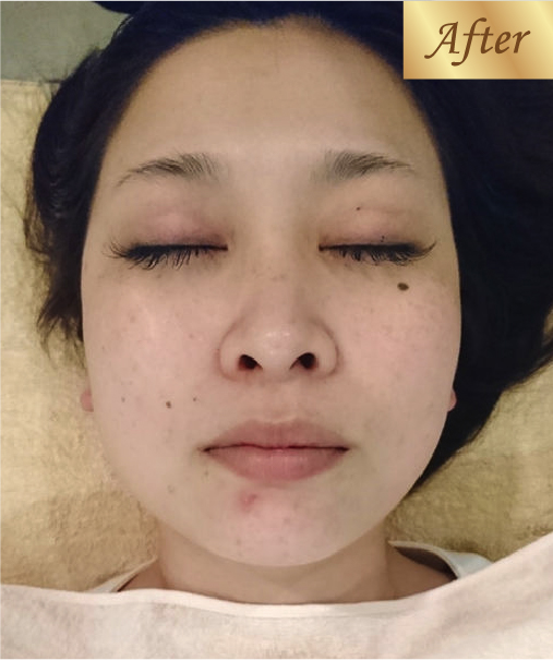 フェイシャルケア after